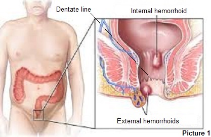 Hemorrhoids From Anal Sex - General Surgery | Nikiforos Ballian, MBBS, FACS